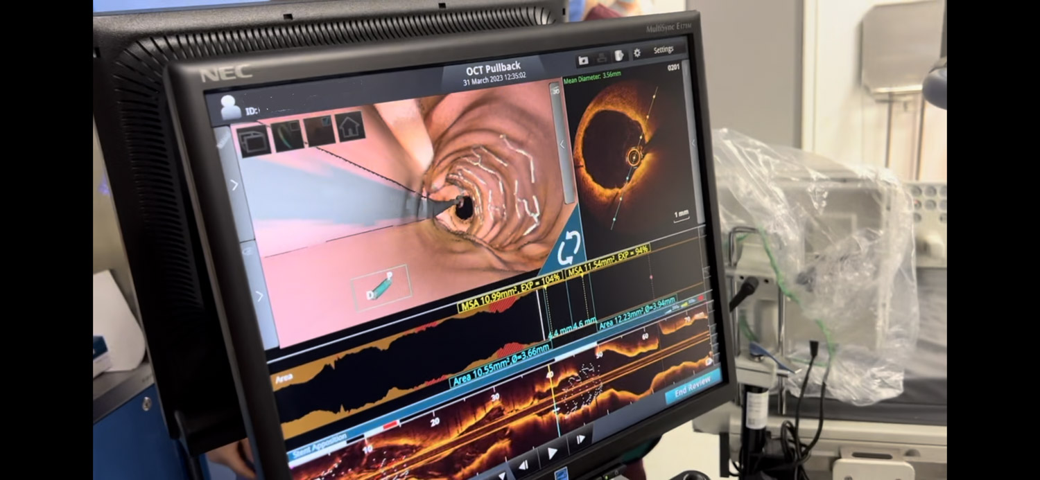 Obraz tętnicy wieńcowej uzyskany z badania OCT wykonanego u jednego z pacjentów łomżyńskiego szpitala